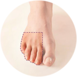 Anterior - Toe - highlighted - Circle 1